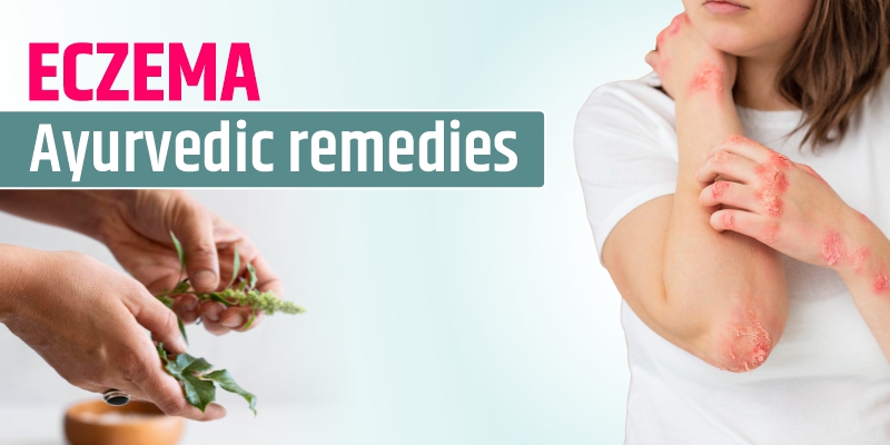 Eczema Ayurveda Remedies